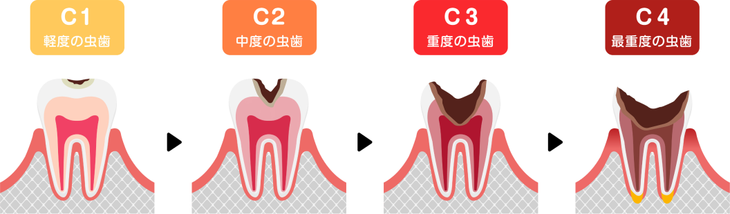 虫歯の進行